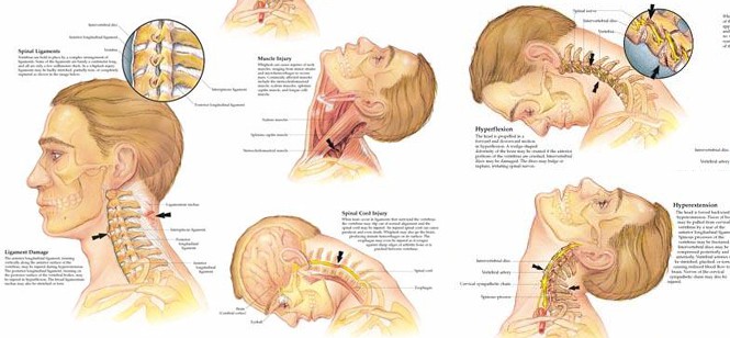 Whiplash Therapy Treatment Newmarket