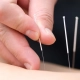 acupuncture newmarket