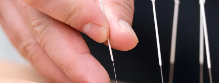 acupuncture newmarket
