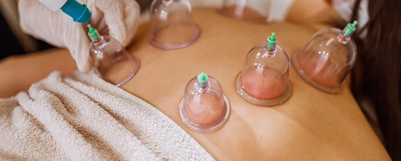 cupping therapy treatment newmarket