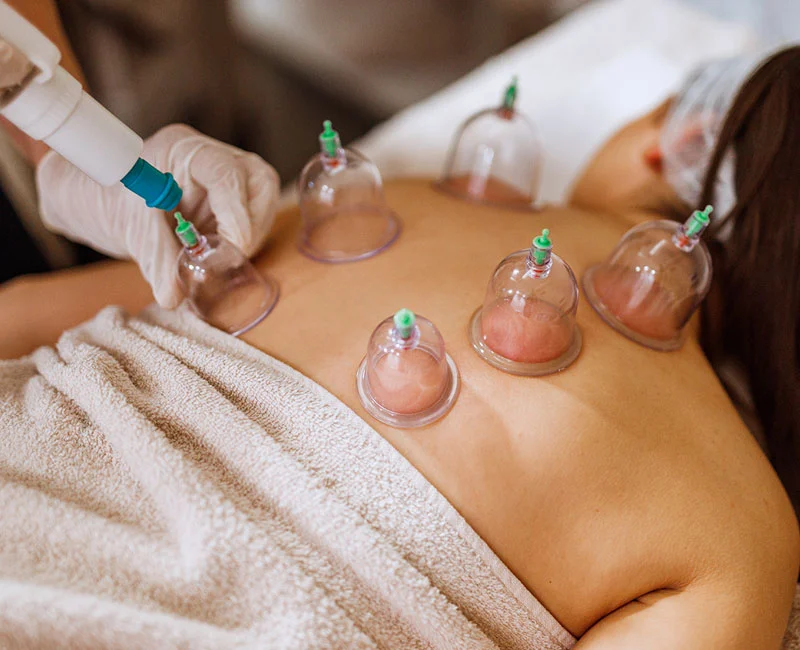 cupping therapy treatment newmarket