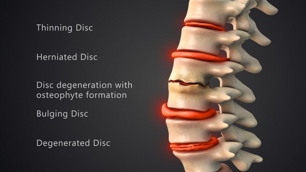 spinal decompression therapy in newmarket ontario