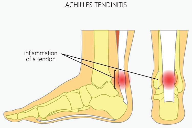Achilles Tendinitis diagram